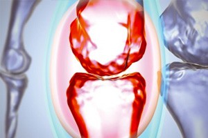 风湿信号莫忽视（上）