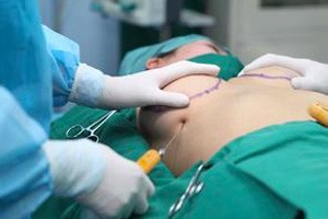 内镜下整形手术隆胸