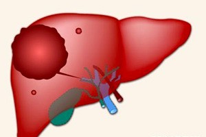 实用肝脏外科学手术精粹巨大肝血管瘤切除术