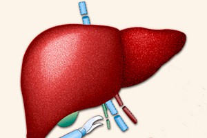 实用肝脏外科学手术精粹肝脏特大恶性肿瘤切除术